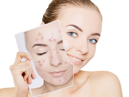 Jak szybko wyleczyć trądzik