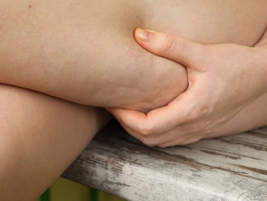 Jakie są rodzaje cellulitu i jak pozbyć się cellulitu?