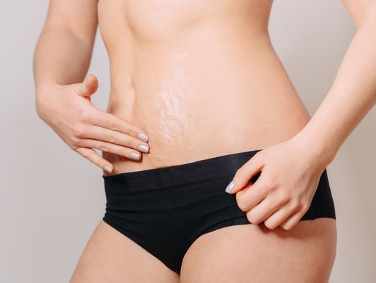 Krem na rozstępy - jaki krem wybrać?