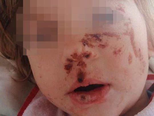 Oblewała córkę żrącą substancją. Dramat dziewczynki spod Łukowa