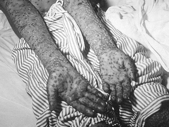 Ospa w powiecie radzyńskim. Nie chcieli się szczepić, choć umierały dzieci i starcy