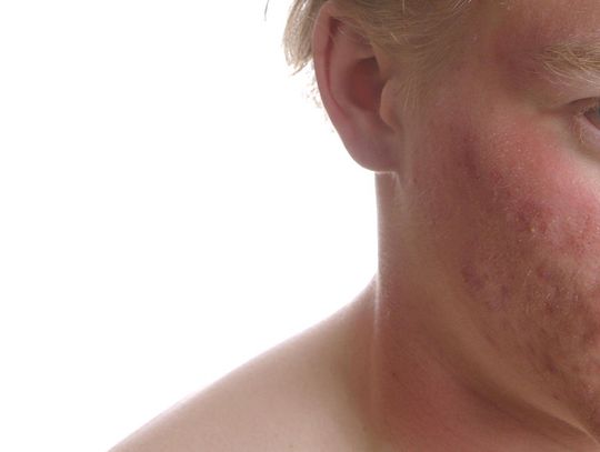 Trądzik różowaty – kosmetyki. Jak je wybrać?