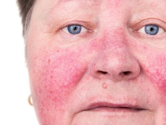 Trądzik różowaty? Zobacz dermokosmetyki Acnerose