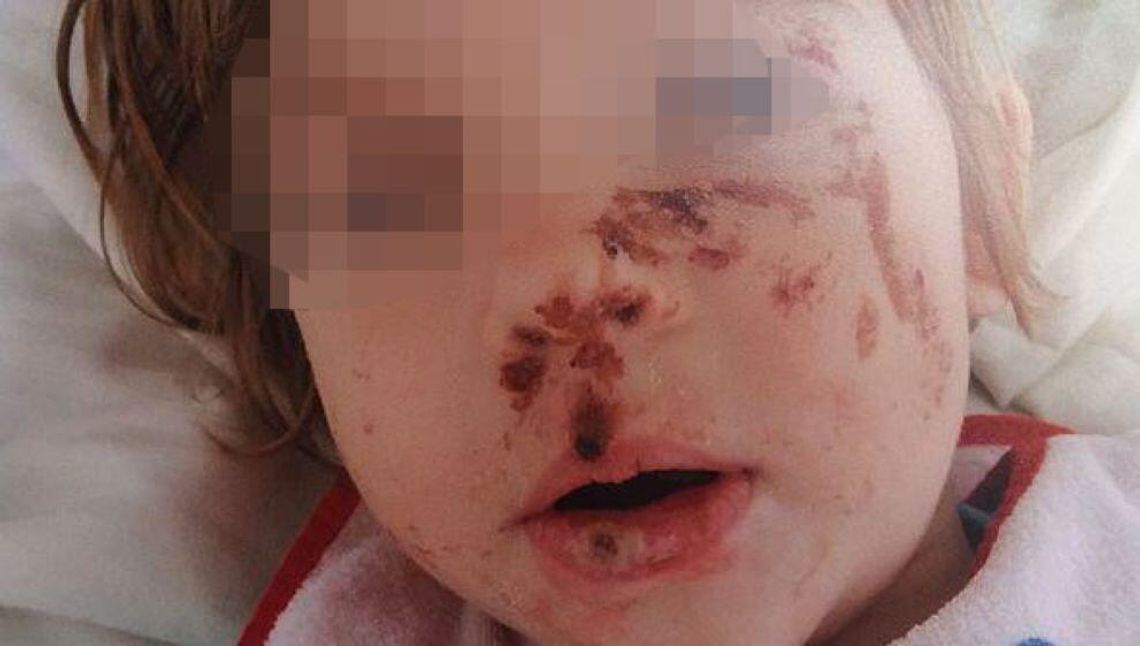 Oblewała córkę żrącą substancją. Dramat dziewczynki spod Łukowa